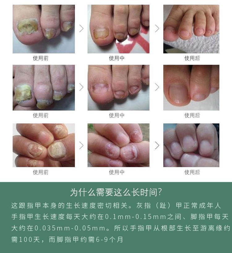 灰指甲抗菌液(圖11) 灰指甲液oem貼牌產品